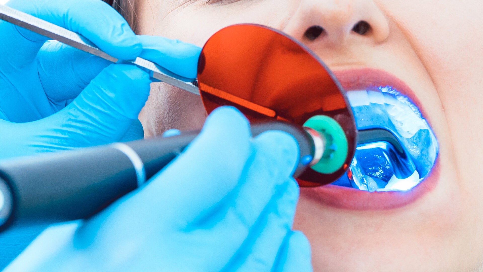 Dental+curing+light+in+patient's+mouth.jpeg