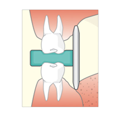 Flow Dental Sticky Bites Blocks for Intra-oral Imaging