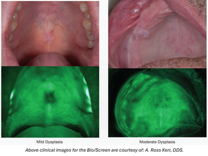 AdDent Bio/Screen Oral Cancer Exam Light - Complete Kit